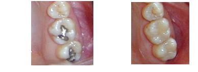 resinasdecomposite